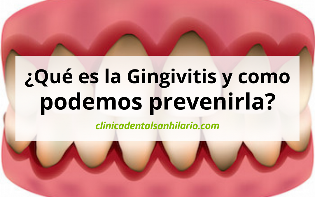 ¿Qué es la Gingivitis y como podemos prevenirla?